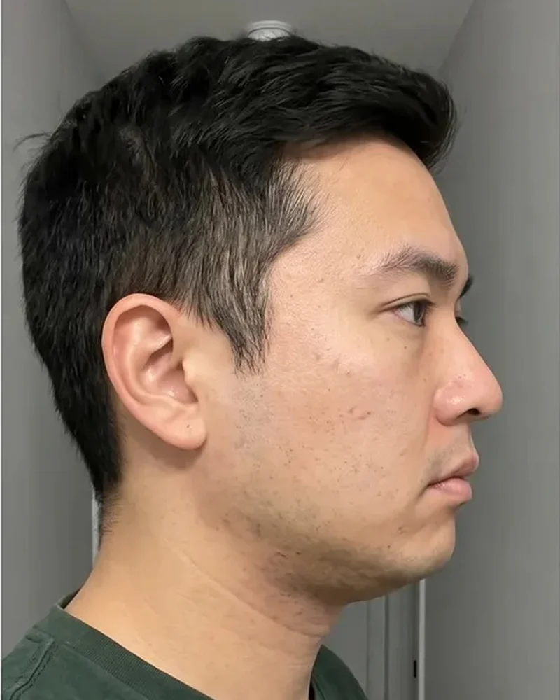 Ilustração do mesmo perfil antes e depois: antes